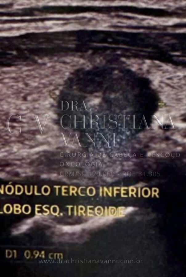 Nódulo de Tireoide (Ultrassonografia)