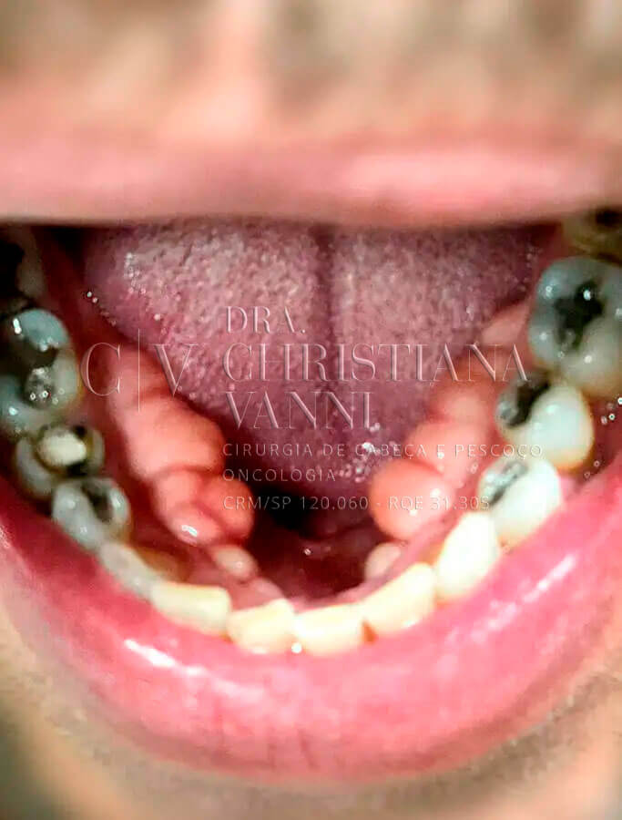 Torus Mandibular