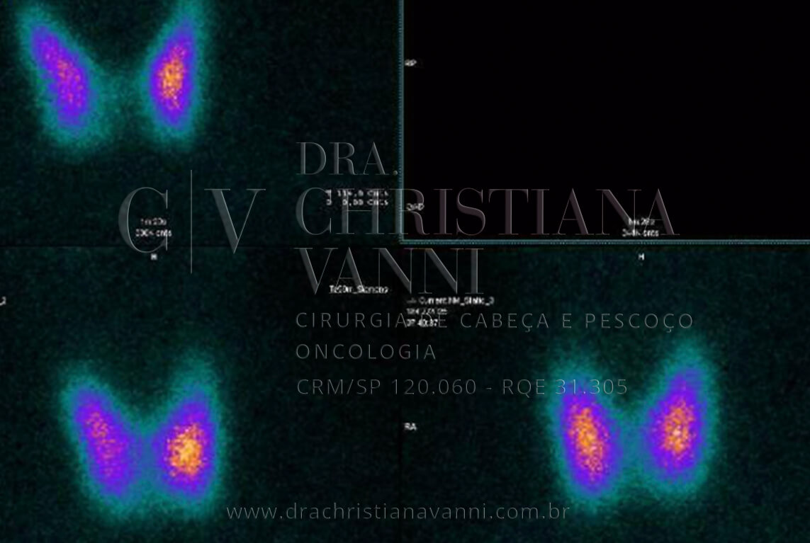 Exame de cintilografia da tireoide