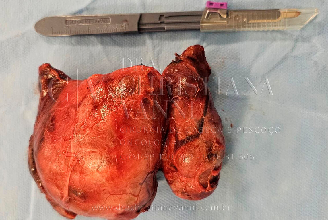 Cirurgia da Tireoide