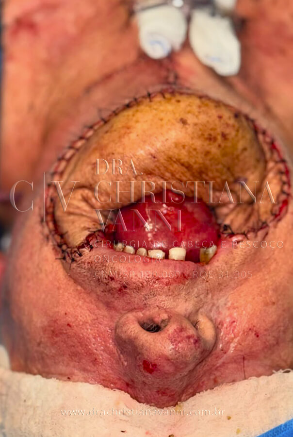 Pós-operatório imediato: o retalho de partes moles posicionado e as suturas evidenciam a reconstrução concluída em tempo único. A nova estrutura mandibular, construída com osso da própria fíbula do paciente, já confere suporte anatômico à região inferior da face