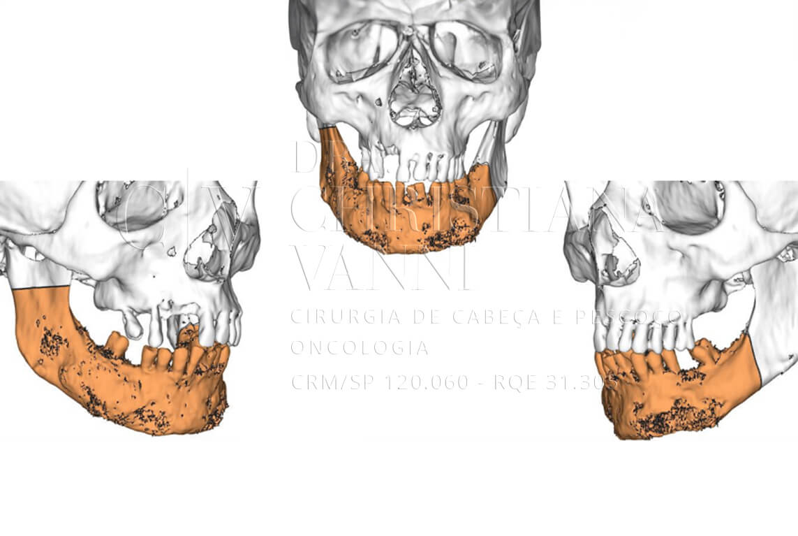 VSLab - Ressecção planejada: área de mandíbula a ser removida (em laranja) demarcada em três vistas do modelo 3D do crânio. O planejamento define com precisão as margens oncológicas antes da cirurgia. Planejamento VSLAB 26.0101.03.05 | Cirurgião: Dra. Christiana Vanni e Equipe