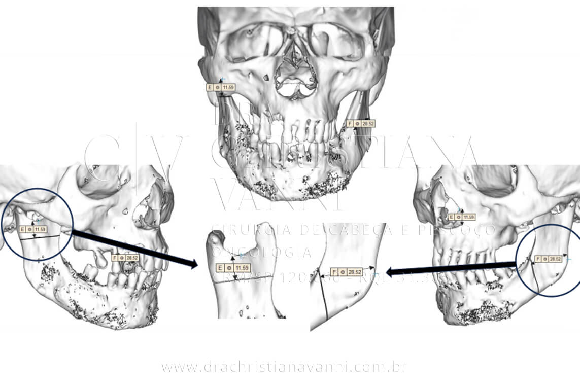 VSLab - Região de corte mandibular: os pontos de osteotomia E (11,59 mm) e F (28,52 mm) demarcados nas vistas frontal e lateral do modelo 3D, com o isolado do segmento ósseo a ser removido ao centro. Esses dados orientam com exatidão os cortes realizados em campo cirúrgico