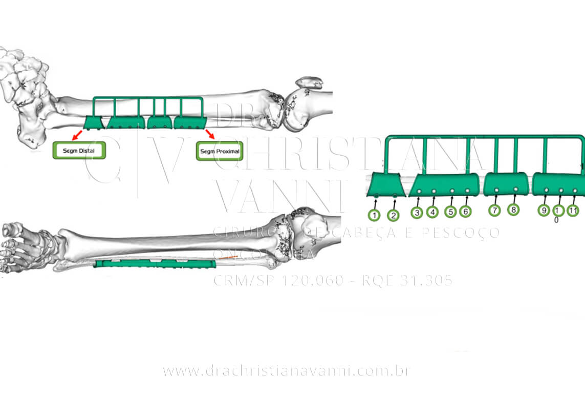 VSLab - Guia de corte da fíbula esquerda: dispositivo personalizado (em verde) posicionado sobre o modelo 3D da fíbula, com 11 pontos de fixação numerados e sistema 2.4. O guia orienta com precisão submilimétrica cada osteotomia da fíbula durante a cirurgia, correspondendo ao guia de posicionamento mandibular