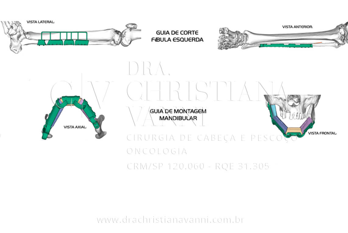 VSLab - Guia de montagem mandibular em vista axial e frontal: a arquitetura completa da nova mandíbula que será implantada. A estrutura do guia orienta o posicionamento de cada segmento da fíbula com precisão anatômica, reproduzindo fielmente o planejamento virtual