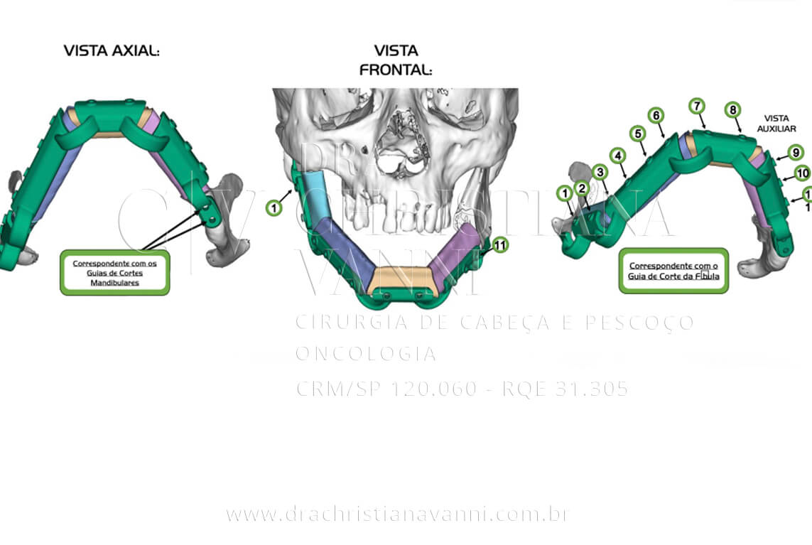 VSLab - Guia de posicionamento e montagem mandibular: os segmentos da fíbula (em cores) encaixados na estrutura do guia, demonstrando como o osso da perna será montado na mandíbula. A correspondência entre o guia de corte da fíbula e os guias de corte mandibulares garante a perfeita integração das peças