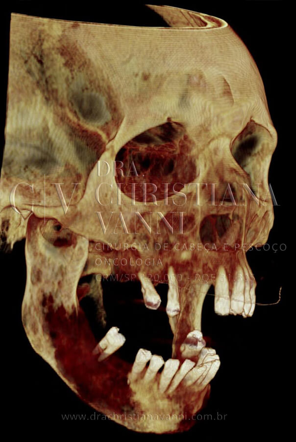 TC 3D - vista lateral esquerda: o deslocamento mandibular e a perda de continuidade óssea ficam ainda mais evidentes nesta angulação. O tumor comprometeu a estrutura óssea de forma difusa, impossibilitando qualquer abordagem cirúrgica sem planejamento virtual preciso