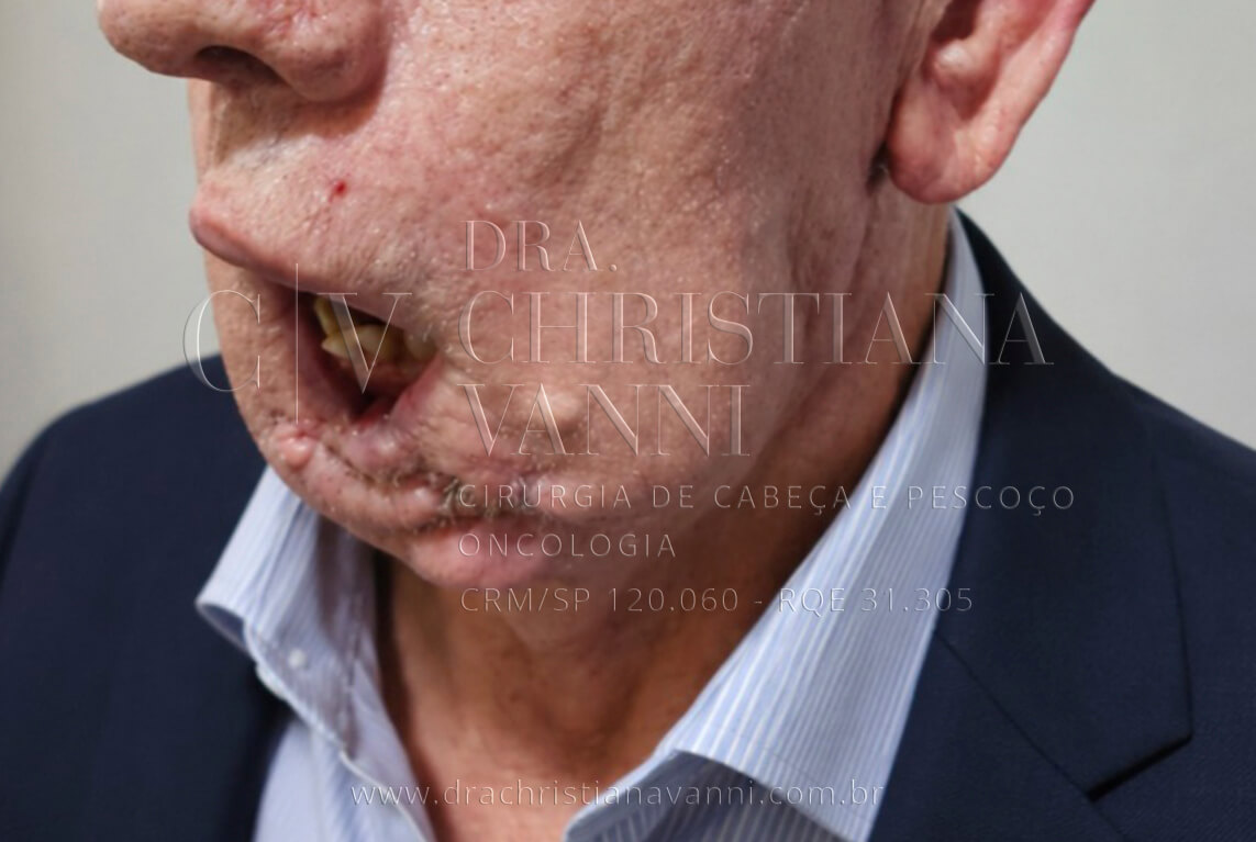 Vista lateral pré-operatória: assimetria facial severa, cicatrizes de procedimentos anteriores e comprometimento da oclusão oral evidenciam a gravidade do caso ao chegar para avaliação com a Dra. Christiana Vanni