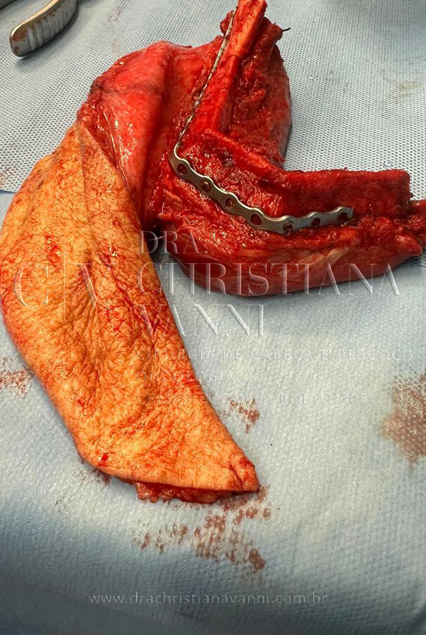 Campo cirúrgico após ressecção: a extensão do defeito mandibular e da região cervical dissecada evidencia a complexidade da reconstrução. Os vasos cervicais são identificados e preparados para receber a anastomose microvascular com o pedículo do retalho de fíbula