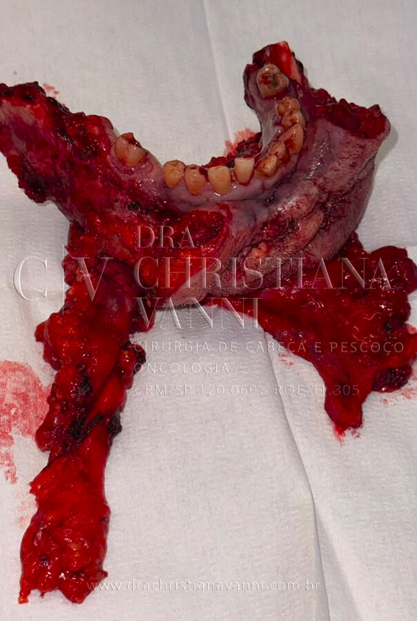 Peça cirúrgica ressecada: a mandíbula destruída e o tumor removidos em bloco, com os tecidos moles comprometidos. A extensão da ressecção evidencia a gravidade do caso e a necessidade de um planejamento 3D preciso para definir as margens corretas