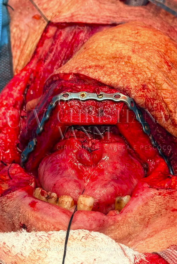 A nova estrutura mandibular, construída com osso da própria fíbula do paciente, já montada na face do paciente com implantes dentários.
