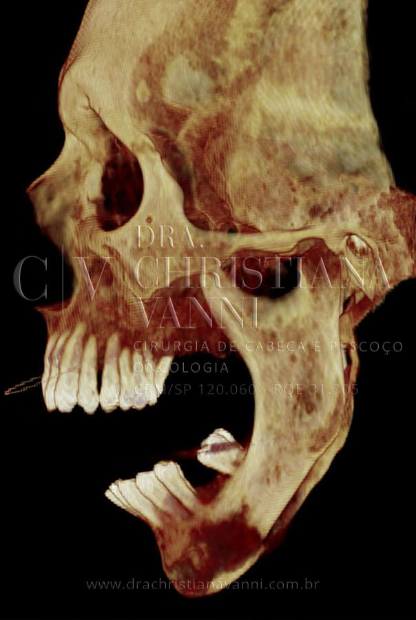 TC 3D - vista lateral direita: terceira angulação confirmando a extensão bilateral da destruição. O conjunto das três vistas foi essencial para o planejamento cirúrgico virtual tridimensional realizado pela VSLab - Dr. Flavio Ferraz em parceria com a Dra. Christiana Vanni