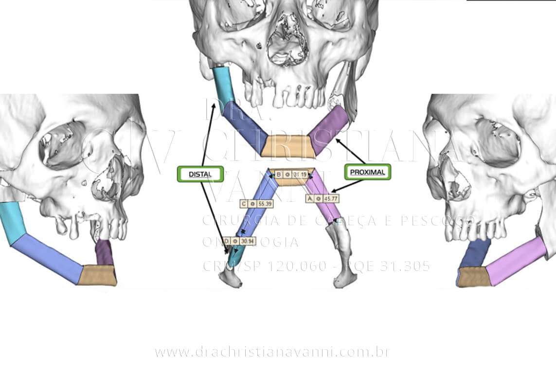 VSLab - Reconstrução planejada: os quatro segmentos da fíbula (em cores distintas) posicionados virtualmente no lugar da mandíbula destruída, com as medidas exatas de cada corte. A correspondência entre distal e proximal garante que a reconstrução reproduza a anatomia original do paciente