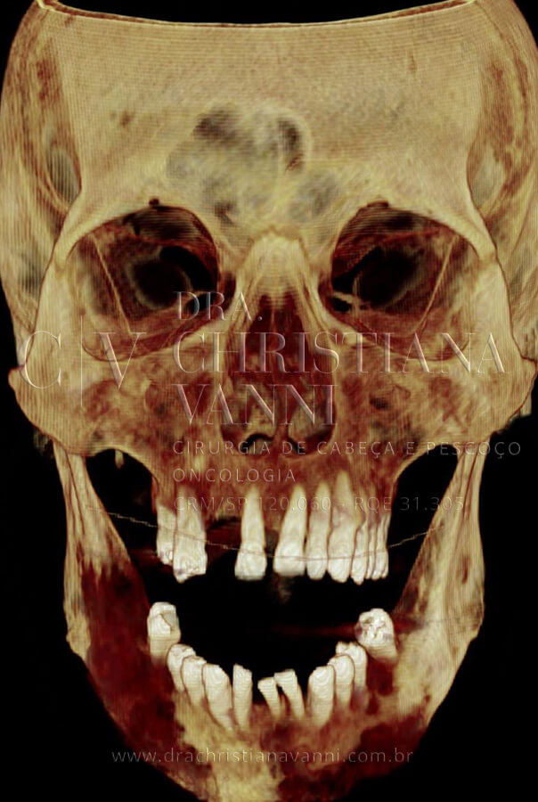 Tomografia computadorizada com reconstrução 3D - vista frontal: as manchas escuras na região mandibular revelam a destruição óssea extensa causada pelo tumor de pele e agravada pela cirurgia anterior inadequada. A irregularidade e fragmentação da mandíbula são visíveis em toda a sua extensão