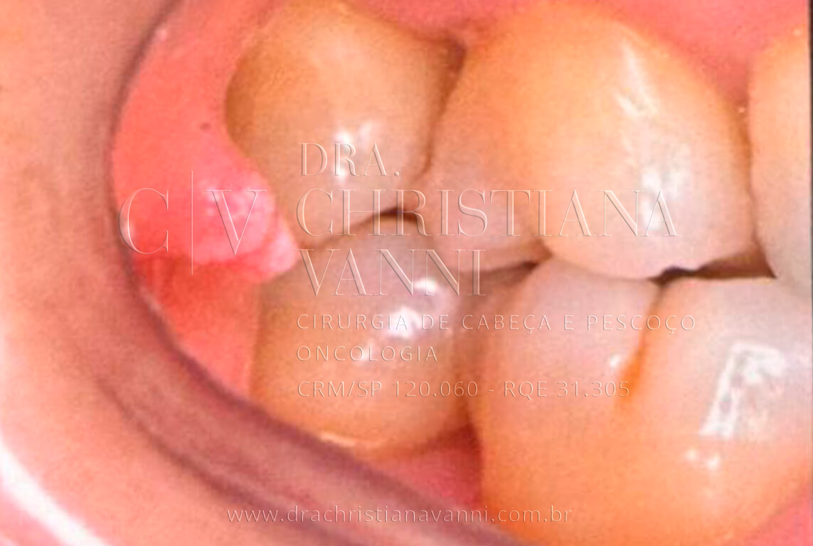 Foto Hpv na Boca (papiloma)