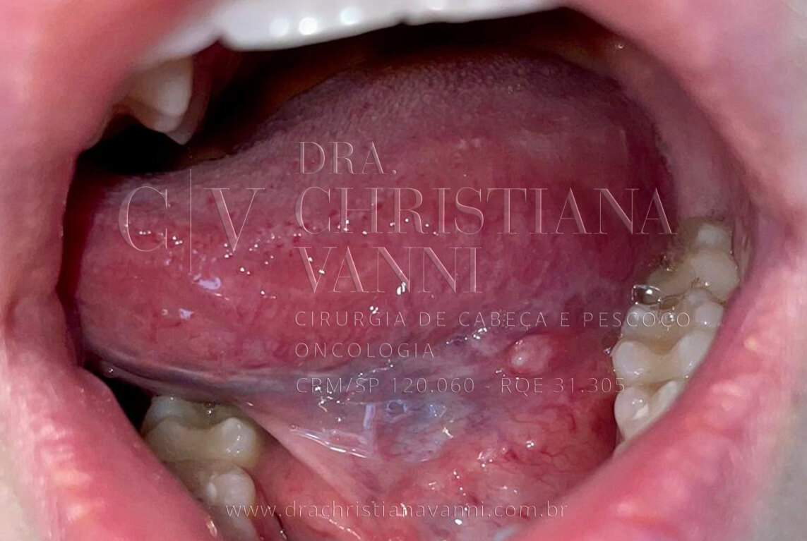 Foto Hpv na Boca (papiloma)